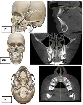 Assessment of root resorption on lateral incisors after primary canine extraction treating mesioangular displaced permanent canines: a randomised controlled trial